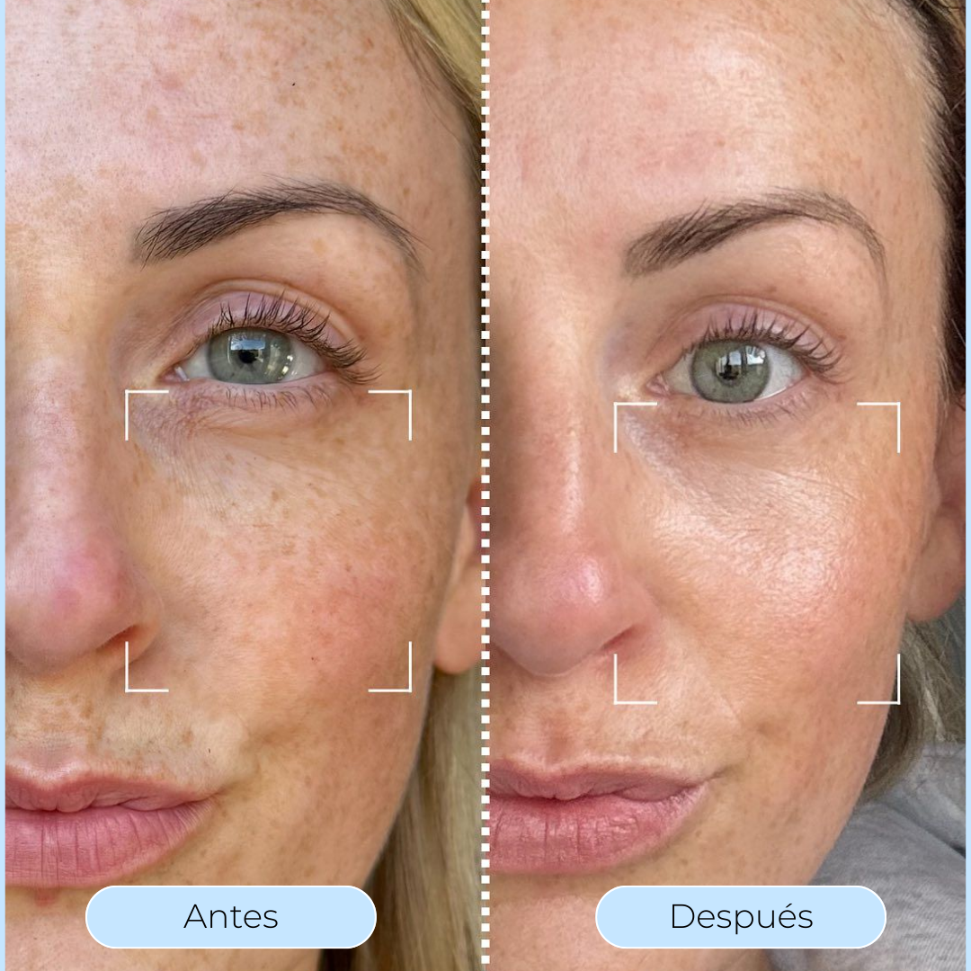 Hydra Derm™ - Piel más lisa y luminosa