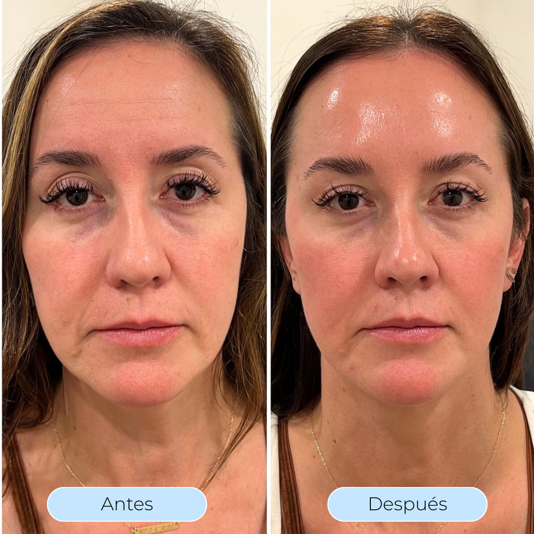 Hydra Derm™ - Piel más lisa y luminosa
