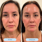 Hydra Derm™ - Piel más lisa y luminosa